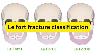 Le fort fracture classification [upl. by Sil]