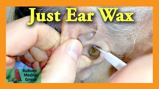 Ear Wax Removal Doctor  Auburn Medical Group [upl. by Kentiggerma]