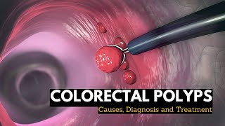 Hyperplastic Polyps Not Always What They Seem [upl. by Carlota533]