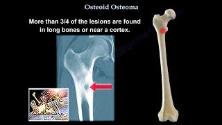 Osteoid Osteoma  Everything You Need To Know  Dr Nabil Ebraheim [upl. by Estrellita]