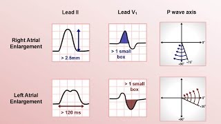 Intro to EKG Interpretation  Chamber Enlargement [upl. by Obla]