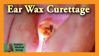 Ear Wax Removal of a Full Ear  Auburn Medical Group [upl. by Merrili]