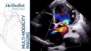 Mitral Valve Regurgitation Evolving Concepts in Diagnosis Prognosis amp Mgmt Zoghbi MD 091219 [upl. by Avlis]