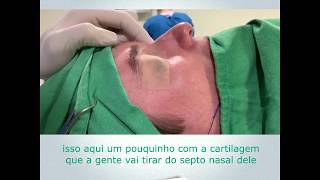 Rinoplastia Perfeita ANTES e DEPOIS  Cirurgia [upl. by Ratcliff]