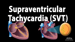 Supraventricular Tachycardia SVT PSVT Animation [upl. by Cuyler]