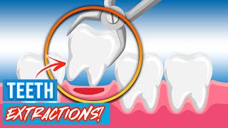 Tooth Extractions For Braces  Why Do Orthodontists Extract Teeth [upl. by Donalt]