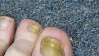 My Toenail Fungus Sucess Story [upl. by Stelmach311]