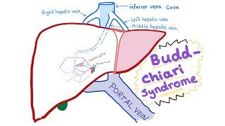 BuddChiari syndrome  Definition Causes Pathophysiology Diagnosis amp Treatment  Hepatology [upl. by Ettolrahs]