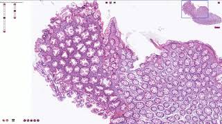 Hyperplastic Polyp  Colon  Histopathology [upl. by Butte678]