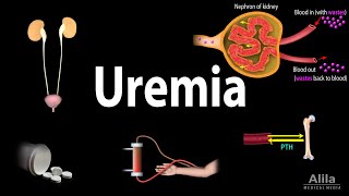 Uremia Pathophysiology Symptoms Diagnosis and Treatment Animation [upl. by Connell]