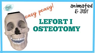 LEFORT I OSTEOTOMY  MAXILLARY OSTEOTOMY [upl. by Tomasina697]