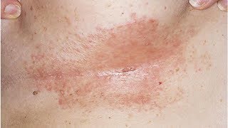 Natural Remedies for Intertrigo Candida of the Skin Folds [upl. by Alhahs815]