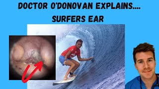 Explaining Surfers Ear aka Exostosis  With Dr ODonovan [upl. by Ahsilem]