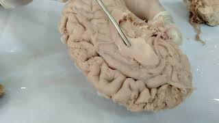 Basal Ganglia of Brain  Neuroanatomy [upl. by Jeana]