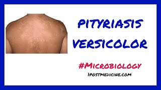 Pityriasis Versicolor  Microbiology [upl. by Jeff107]