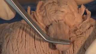 Cranial Nerves Neuroanatomy Video Lab  Brain Dissections [upl. by Comethuauc]