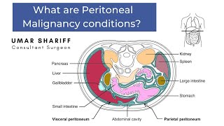 Peritoneal Malignancy conditions [upl. by Novi600]