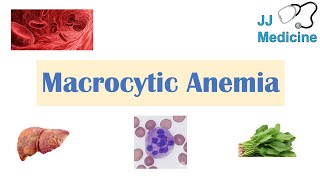 Macrocytic Anemia  Megaloblastic vs NonMegaloblastic  Approach amp Causes [upl. by Lesak820]