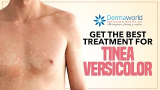 Get The Best Treatment for Tinea Versicolor [upl. by Ocirnor]