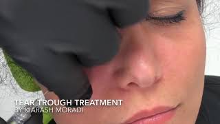 Mörka ringar under ögonen med fillers  Tear Trough Treatment by Kiarash Moradi [upl. by Nemhauser]