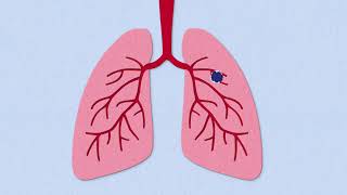 Fibrosis Explained [upl. by Makell223]