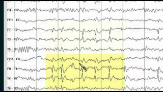 Focal EEG Abnormalities 1 [upl. by Stacey]