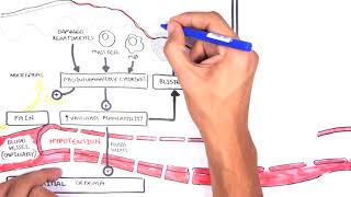 Burns DETAILED Overview  Types Pathophysiology TBSA [upl. by Barney799]