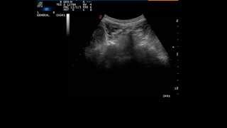 Ultrasound guided facet joint injection 2 L5S1 [upl. by Lap615]