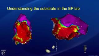 Cardiac Catheter Ablation What to Expect [upl. by Romalda]