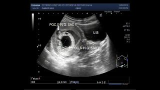 Ultrasound Video showing miscarriage of early twin pregnancy [upl. by Oleta]