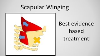 Scapular Winging Causes and Treatment [upl. by Joline]