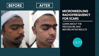 Microneedling RadiofrequencyRF Treatment Before And After Results  Oliva Clinic [upl. by Rives]