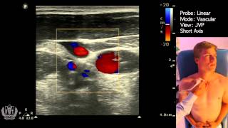 JVP Jugular Venous Pulsation Evaluation using Ultrasound [upl. by Macmahon649]