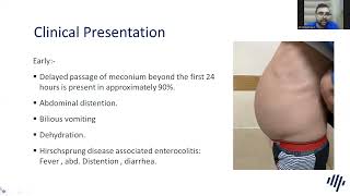 Hirschsprung Disease Pathology [upl. by Hgiellek]