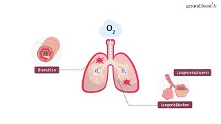 Was ist eine chronisch obstruktive Lungenerkrankung COPD [upl. by Alburga]