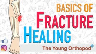 Fracture Healing  ANIMATION  BASICS  The Young Orthopod [upl. by Churchill]