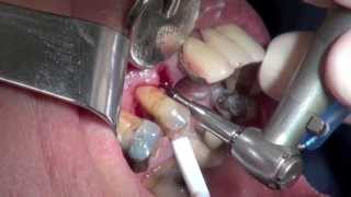 Premolar Extraction with Invisalign  Incredible Transformation amp Case Study [upl. by Bryana787]