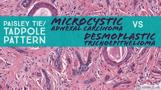 Microcystic Adnexal Carcinoma vs Desmoplastic Trichoepithelioma Paisley TieTadpole Pattern [upl. by Con]