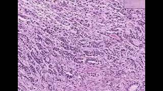 Histopathology StomachAdenocarcinoma [upl. by Rennold931]