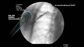 Arrow® EZIO® System  Proximal Humerus Infusion Fluoroscopy Adult Alert Patient [upl. by Tratner71]