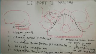 LE FORTII FRACTURE LINE [upl. by Boothe]