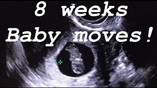 8 weeks ultrasound Baby moves [upl. by Ainoz]