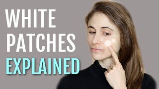 WHITE PATCHES ON THE FACE EXPLAINED PITYRIASIS ALBA DR DRAY [upl. by Supple]