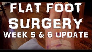 Flat Foot Surgery Recovery Week 5 amp 6 [upl. by Ado]