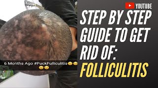 Step by step guide to get rid of folliculitis [upl. by Isnam]