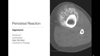 Bone Tumors  Periosteal Reaction  Radiology Basics [upl. by Monteith]