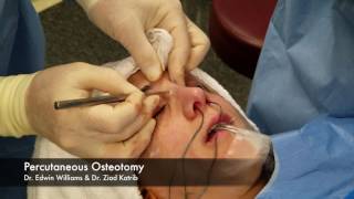 Percutaneous Osteotomy amp Breaking the Nose During Rhinoplasty Surgery [upl. by Gunn]