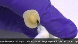 Como cementar Incrustación dental Overlay composite o cerómero tratamiento de incrustación Parte I [upl. by Sophy]