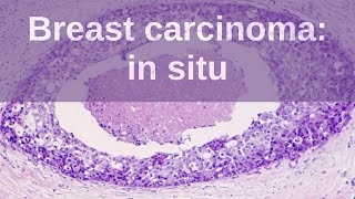 Breast Carcinoma in situ  Pathology mini tutorial [upl. by Crispin]