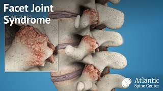 Facet Joint Syndrome [upl. by Nanis]